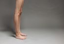 Comment prévenir ou réduire les varices : bienfaits du drainage lymphatique réduire les varices