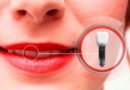 Les complications possible après la pose d'implant dentaire