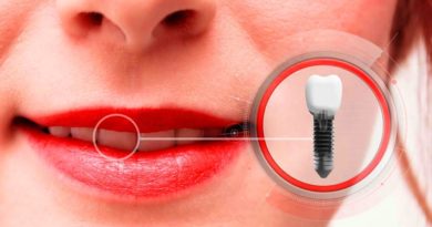 Les complications possible après la pose d'implant dentaire