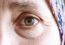 Gros plan sur les paupières d'une femme mature présentant un relâchement cutané.